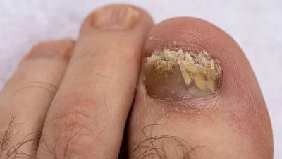 Tırnak mantarı, tırnaklarda enfeksiyon oluşturan bir durumdur ve genellikle tedavi