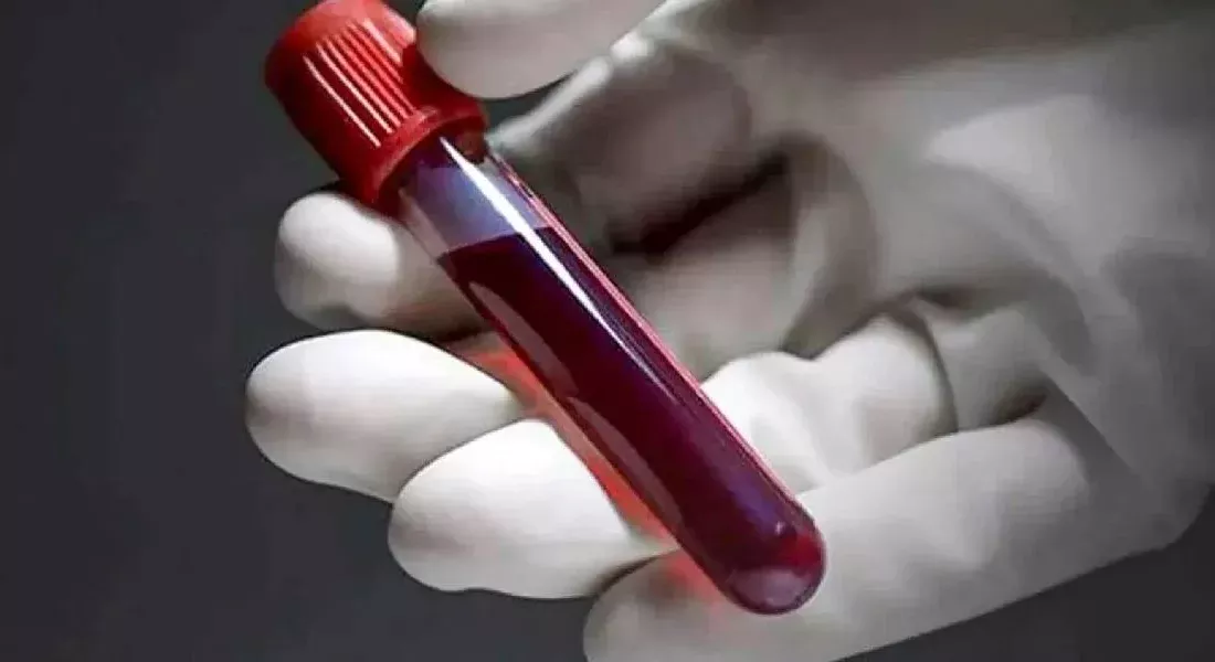 Kan grubunuz sağlığınızı doğrudan etkiliyor! En ölümcül hastalığa yakalanma riski bile belli: O kan grubu olanlar dikkat Yeni yapılan bir araştırma, kan grubunun sağlık üzerindeki önemli etkilerini