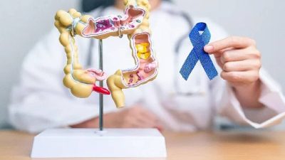 Kolon kanseri, genellikle 50 yaş üstü bireylerde görülen ve tüm