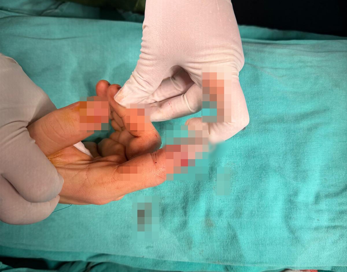 Balıkesir’in Bandırma ilçesinde yaşanan asansör kazasında parmağı kopan bir vatandaş,