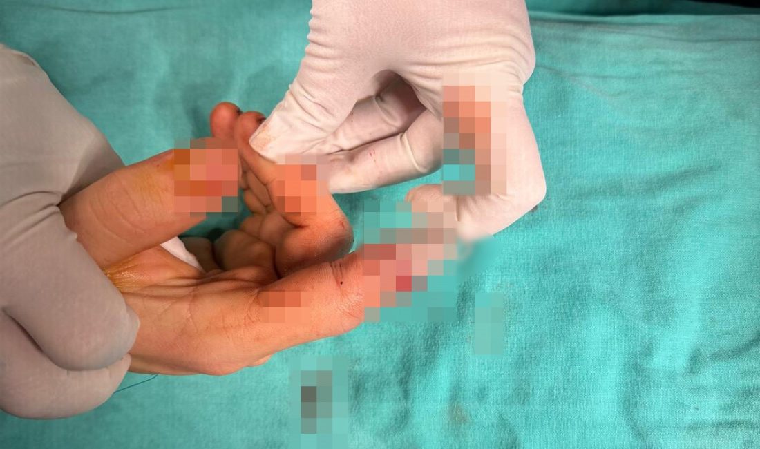 Bandırma’da asansör kazasında kopan parmak başarılı ameliyatla kurtarıldı Balıkesir’in Bandırma ilçesinde yaşanan asansör kazasında parmağı kopan bir vatandaş,